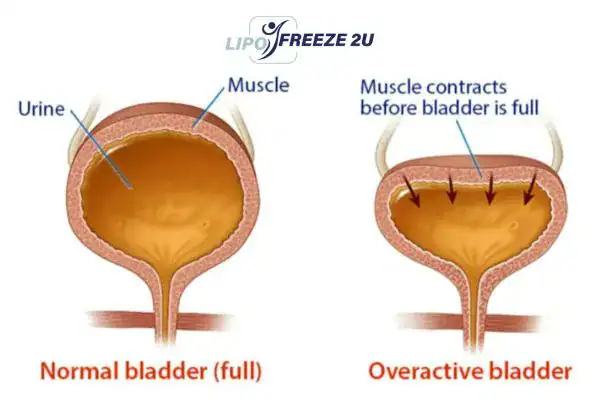 diagram of overactive bladder treatment Ashbourne