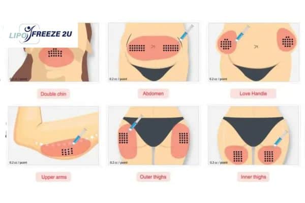 Benefits of Choosing Aqualyx for Fat Reduction Ashbourne
