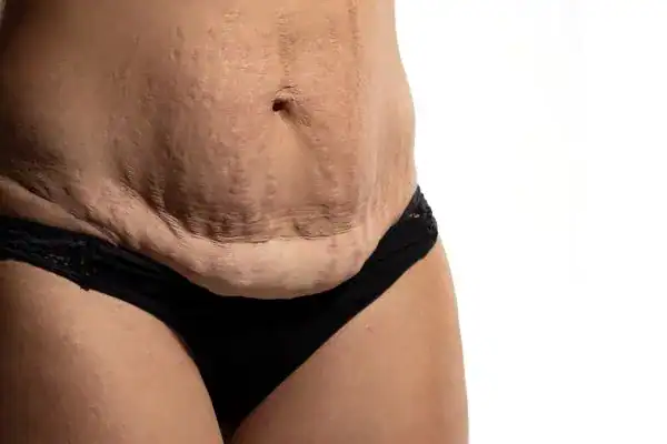 loose skin after weight loss injections Ashbourne