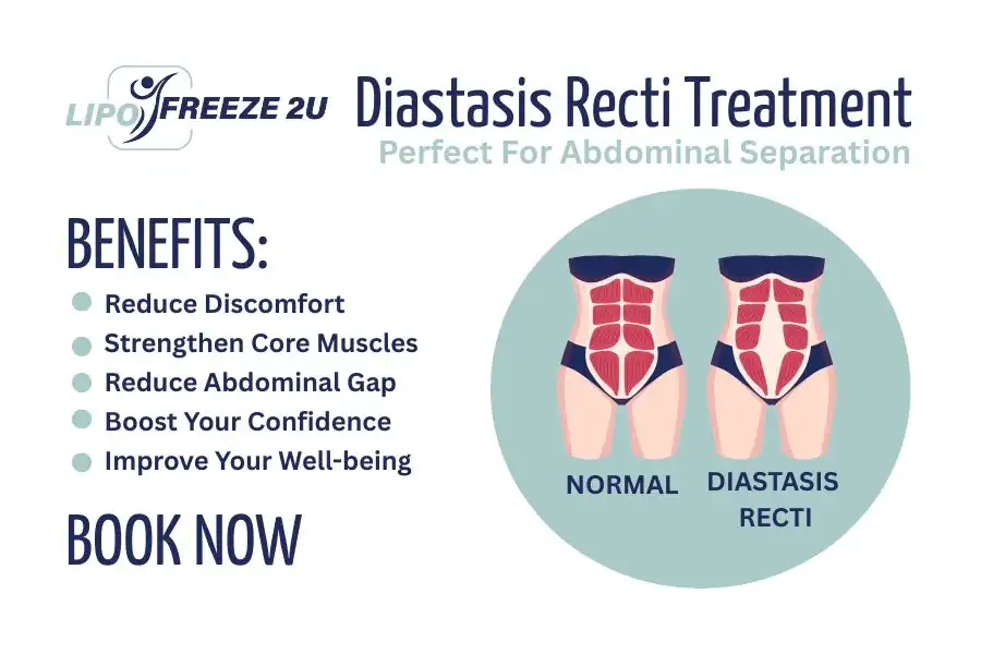 How Long Will It Take to See Improvements in Diastasis Recti Ashbourne
