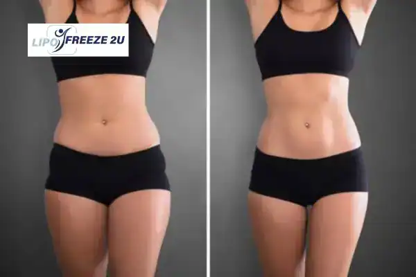 How Can LIPO FREEZE 2U Support Your Post-Pregnancy Body Recovery Ashbourne?