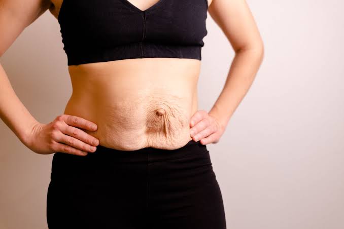 Is Surgery Really the Only Way to Repair Diastasis Recti Ashbourne?