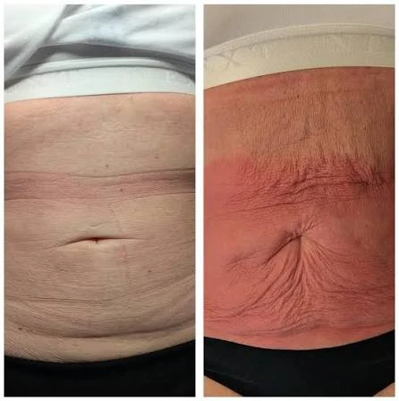 How Does RF Microneedling Improve Crepey, Thin and Uneven Skin Texture Ashbourne?