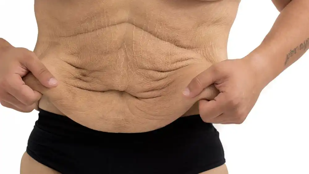 RF Microneedling for Loose Skin: How Can It Help Tighten and Reshape the Skin Ashbourne?